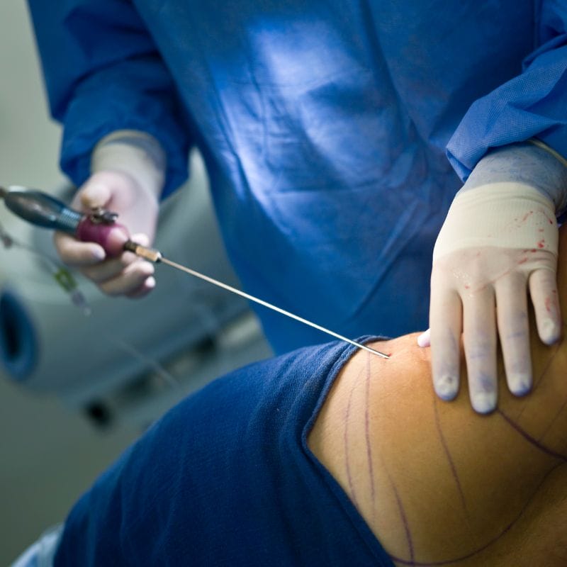 liposuction procedure