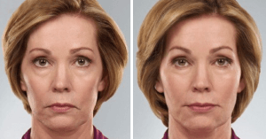 Juvederm-Voluma-XC-Before-and-After-Photo