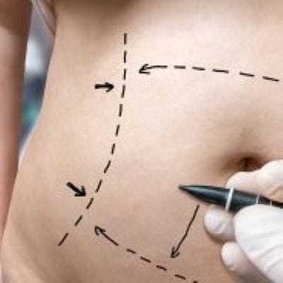 purpose of liposuction