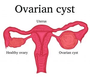 ovarian-cysts-diagram-AdobeStock_169410300-1