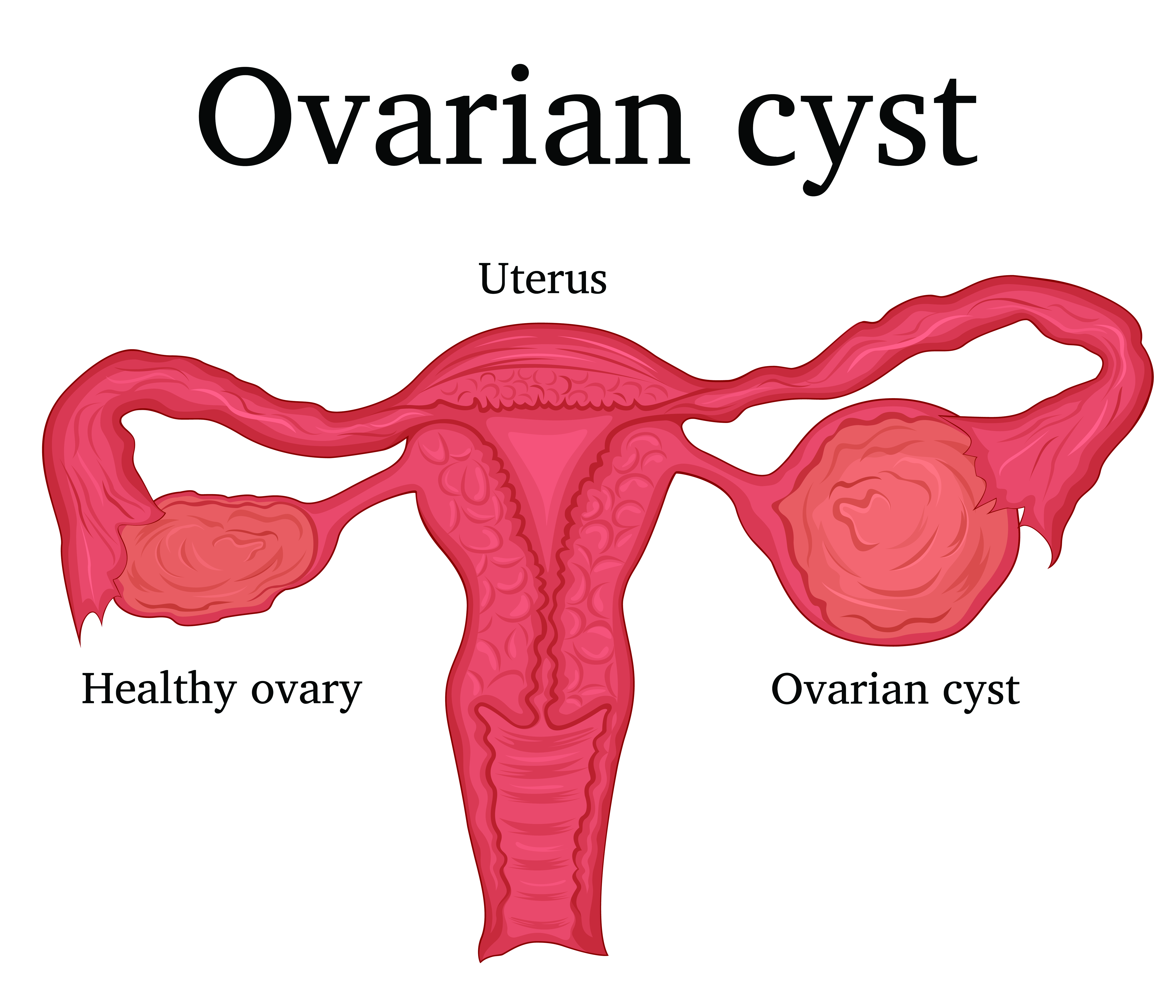 ovarian-cysts-diagram-AdobeStock_169410300-1