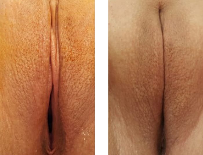 24 YR OLD VAGINOPLASTY 6 WEEKS POST OP