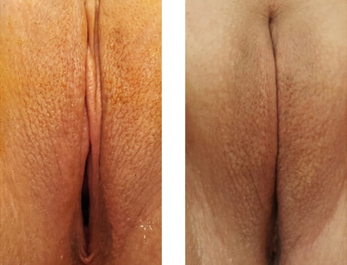 25 YR OLD VAGINAL REJUVENATION - copy