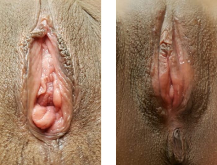 39 YR OLD VAGINOPLASTY, LABIAPLASTY OF MINORA AND MAJOR 8 WEEKS POST OP - copy