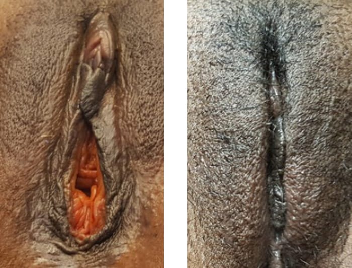 40 YR OLD VAGINOPLASTY 8 WEEKS POST OP - copy