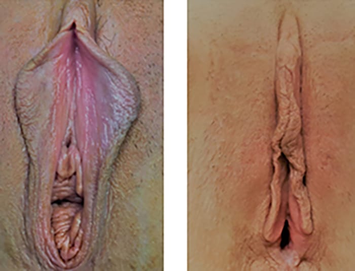 41 YR OLD VAGINAL REJUVENATION - copy