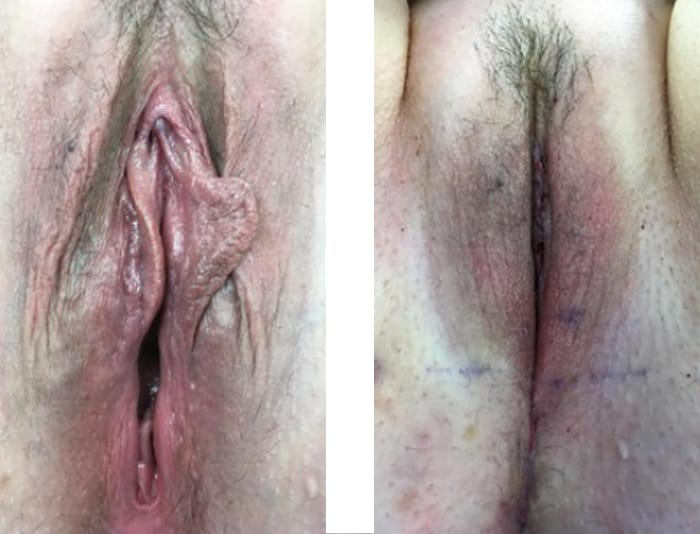 42 YR OLD VAGINOPLASTY AND LABIAPLASTY SAME DAY POST OP - copy