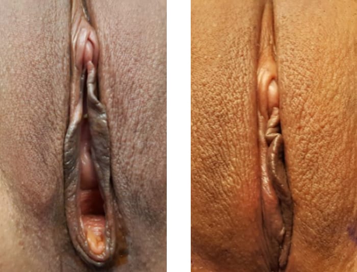 43 YR OLD VAGINOPLASTY SAME DAY POST OP - copy