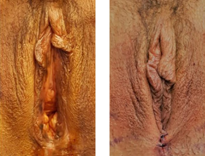 44 YR OLD VAGINOPLASTY SAME DAY POST OP - copy