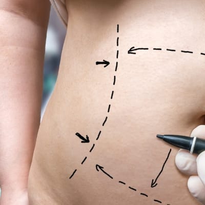 liposuction belly markings