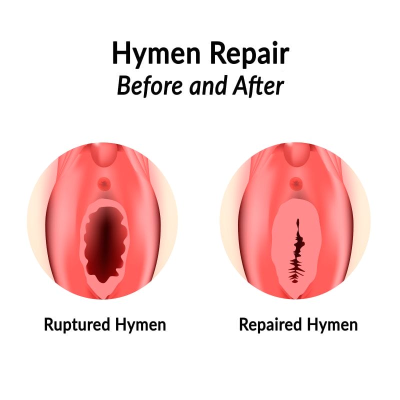 hymen-repair-diagram-before-after_309721578-1