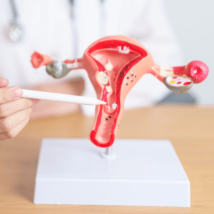 Uterine Fibroid Embolization (UFE) for Heavy Bleeding